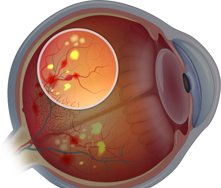 Improving Vision with Best Practices in Diabetic Eye Disease Treatment