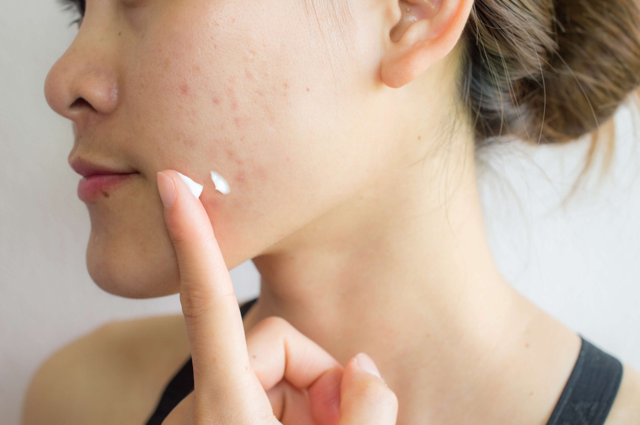 How to Reduce Pore Size: Solutions That Work in Singapore